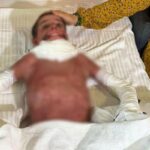 Mangal yaparken vücudunun yüzde 50’si yandı! 11 yaşındaki Mustafa’ya yapay deri nakli yapıldı…