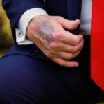 O ziyaret sırasında dikkat çekti! ABD Başkanı Trump’ın elindeki morluk gündem oldu: Beyaz Saray’dan açıklama geldi
